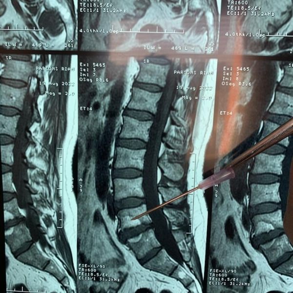 Tratamiento para el dolor de ciática en Tijuana